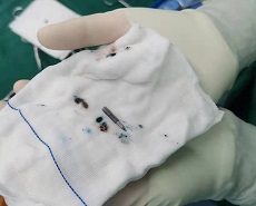 多学科协作 | 青滨附院成功完成一例小儿面部异物取出术