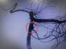 上新了 | 青滨附院神经外科：“管”内介入栓塞，毫厘间挽救危重患者生命