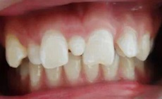 乳牙早失、乳牙滞留、多生牙……这些儿童错颌畸形需要及早干预