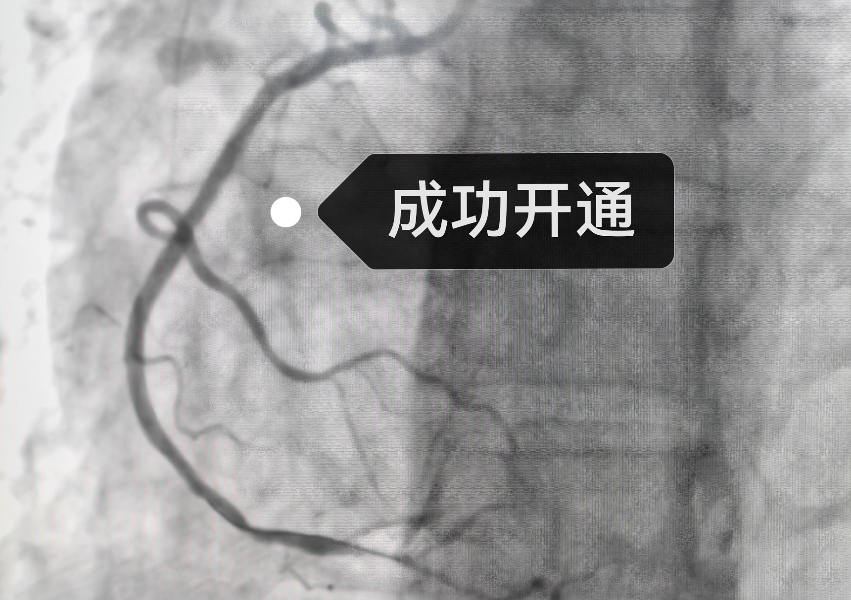 两次手术，四枚支架，通！